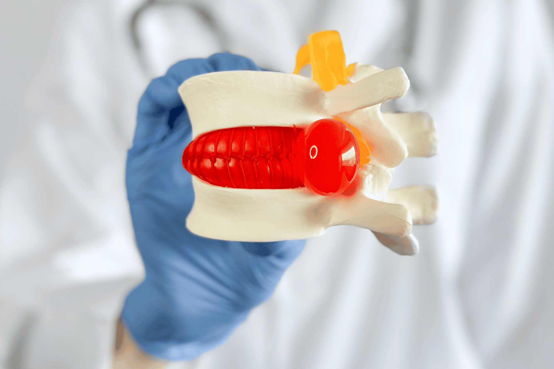 facet joint arthritis and herniated discs