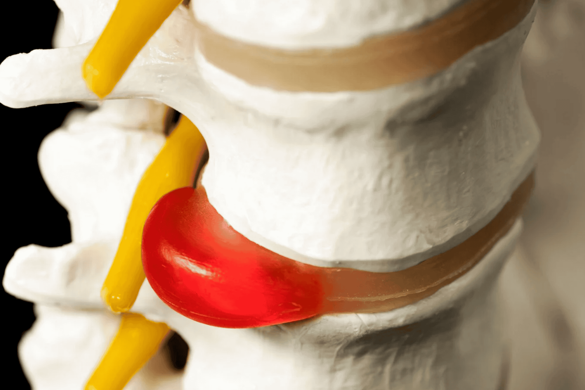 herniated disc and bulging disc